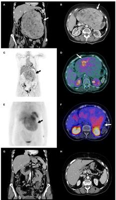 Calcitriol-Mediated Hypercalcemia, Somatostatin Receptors Expression and 25-Hydroxyvitamin D3-1α- Hydroxylase in GIST Tumors